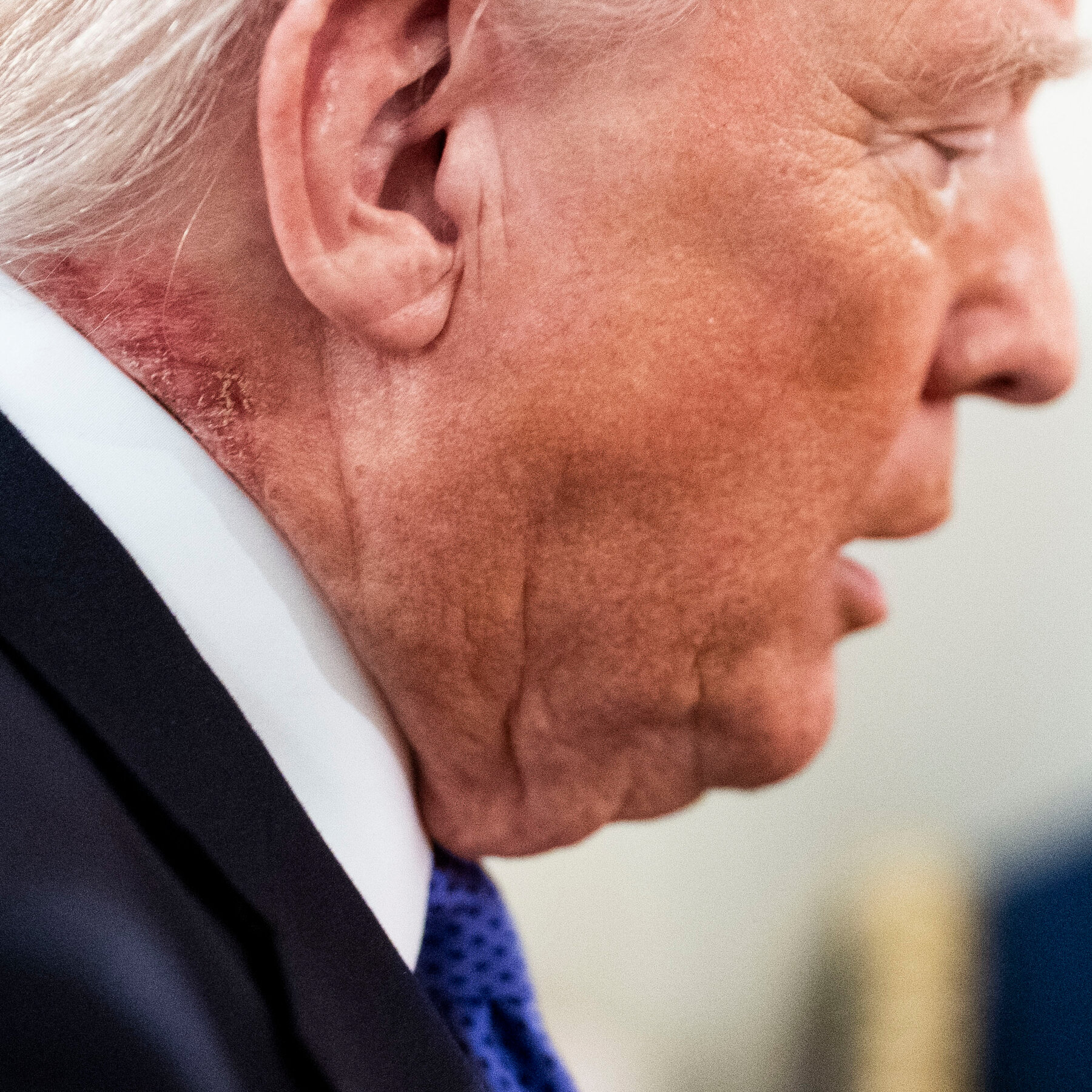 What Is Trump’s Neck Rash? His Doctor Declines to Explain.