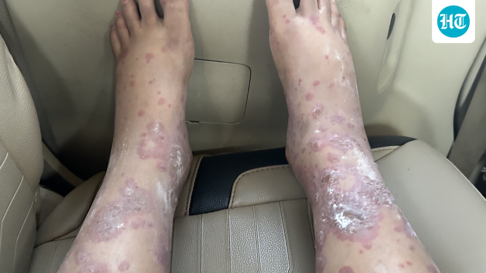 ‘Ruined my trip’: Woman claims fungal infection after Akasa Air travel, airline responds