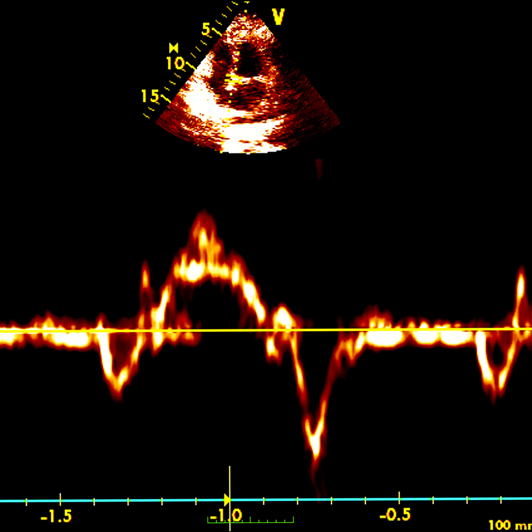 Women Who Undergo Menopause Before 40 Face Higher Heart Attack Risk