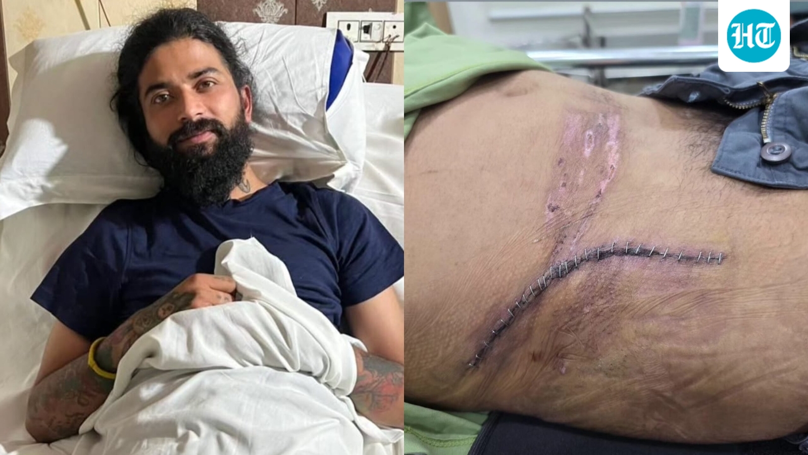 Anurag Dobhal shows injury scars from car crash, seeks fans' advice on comeback: 'New zindagi ki shuruaat dekhoge?'