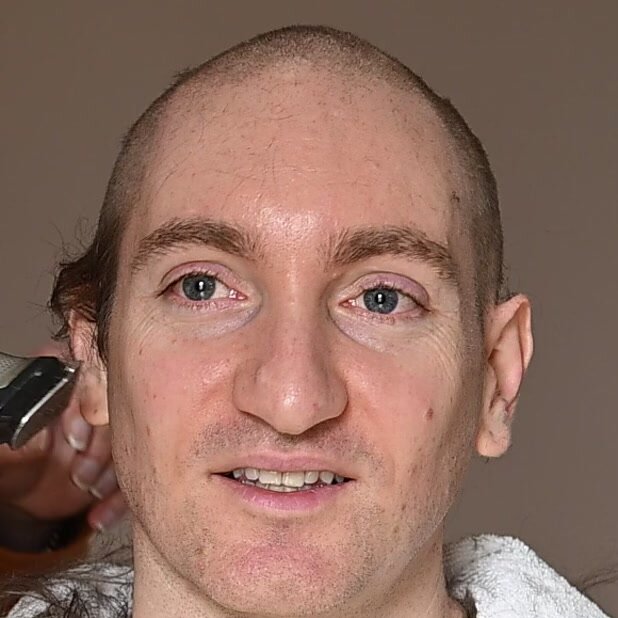 How Bald Reddit Helps People Manage Hair Loss