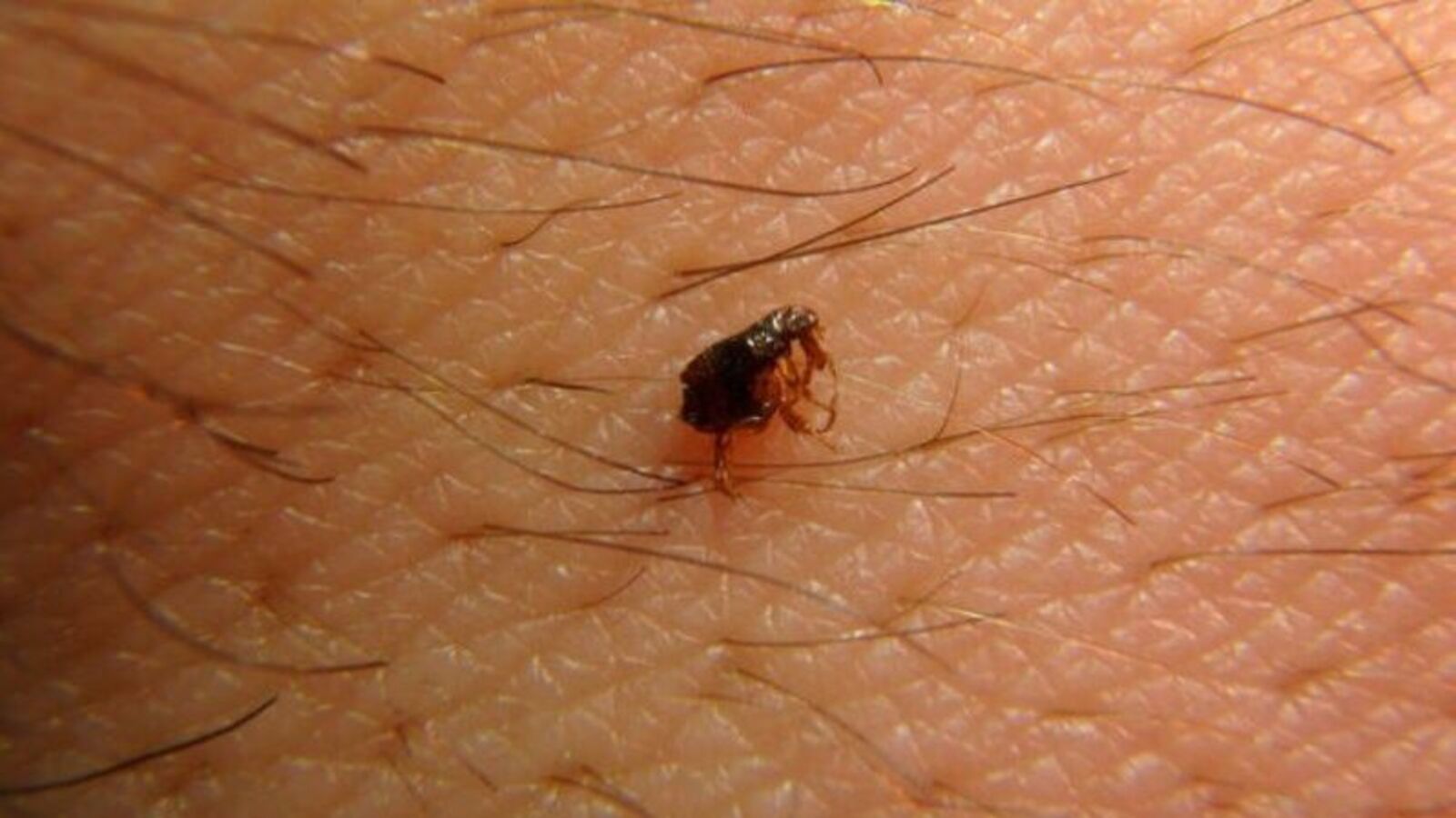 Can scrub typhus cause death? Treatment, symptoms, diagnosis, causes - all you need to know