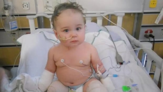 Alberta girl awarded damages in lawsuit over infection leading to quadruple amputation