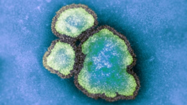 Quebec says measles outbreak has ended