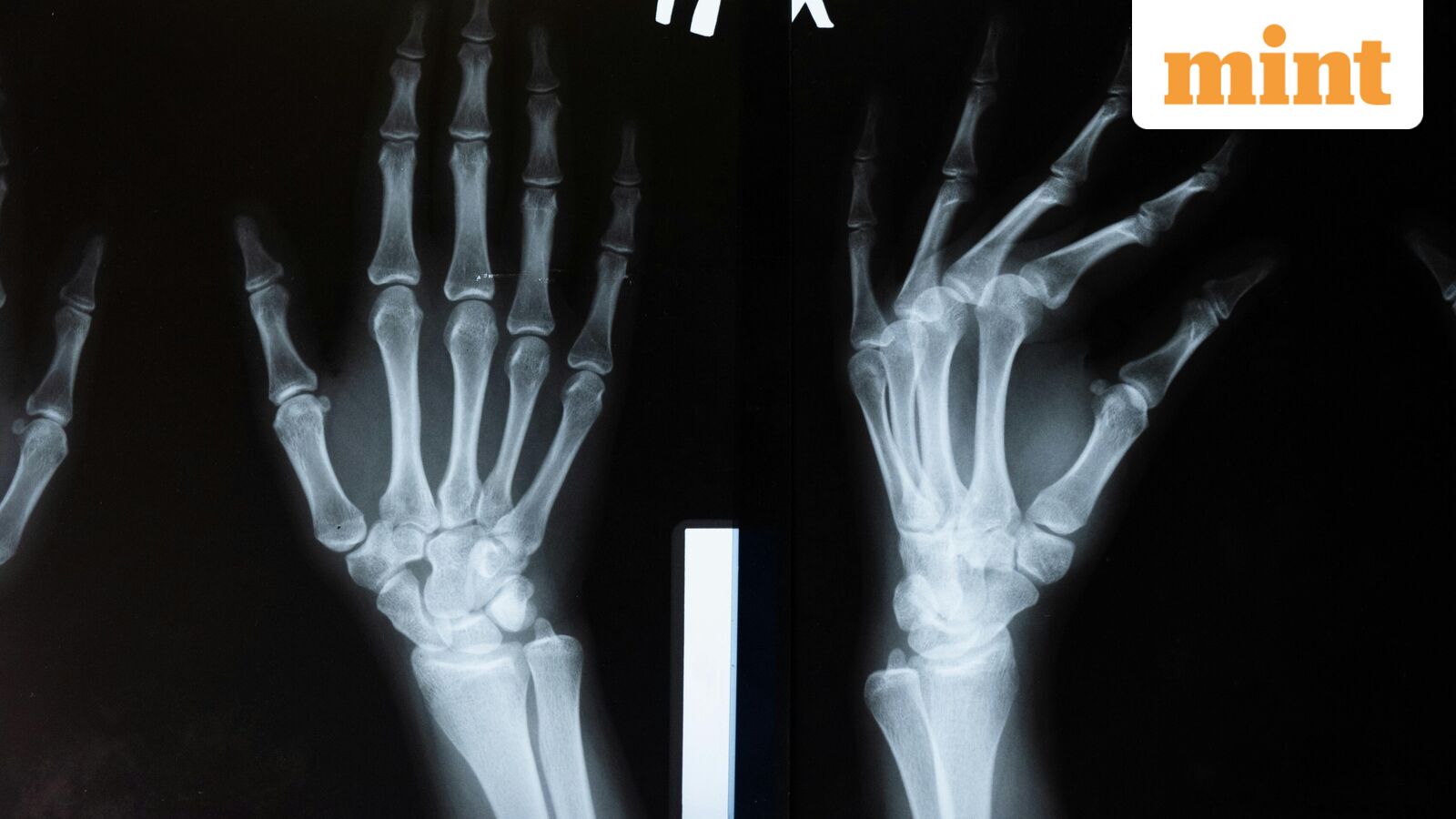 Chinese scientists develop ‘bone glue’ that heals fractures in just 3 minutes