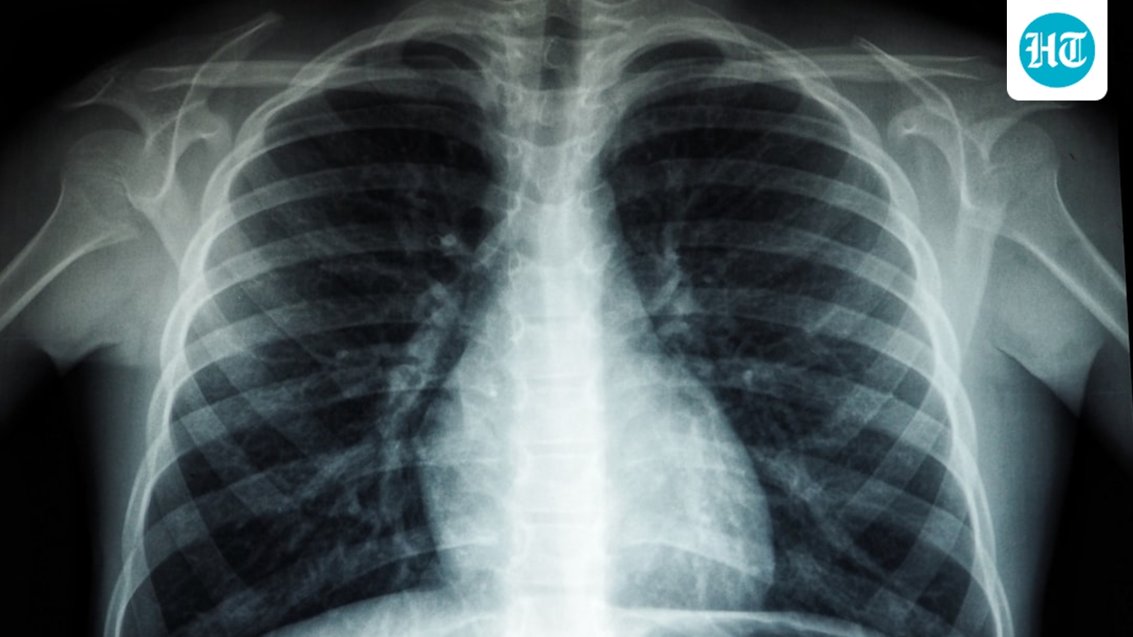 Over 6,100 new TB cases in Maharashtra in 35 days; 11,091 villages flagged as high risk
